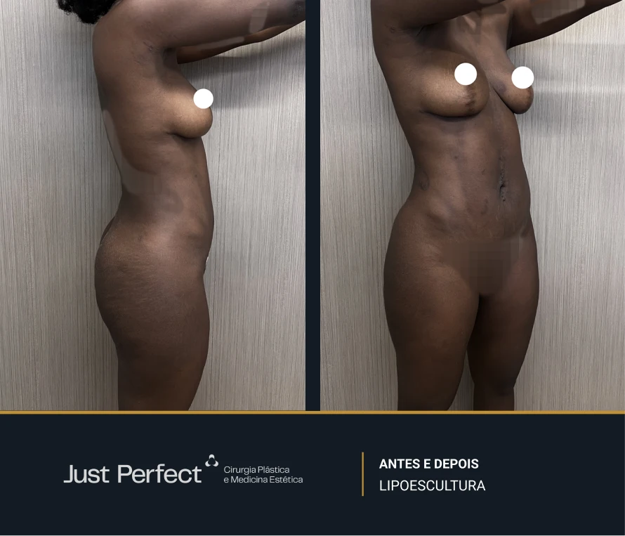 JP_-_antes_e_depois_-_Lipo_11