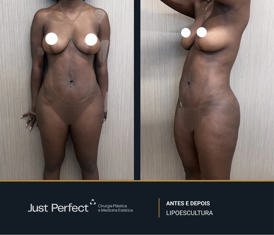 JP_-_antes_e_depois_-_Lipo_12