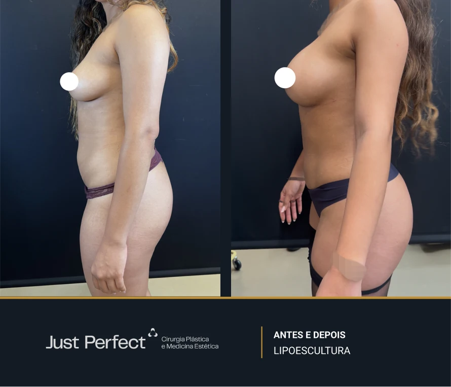 JP_-_antes_e_depois_-_Lipo_4
