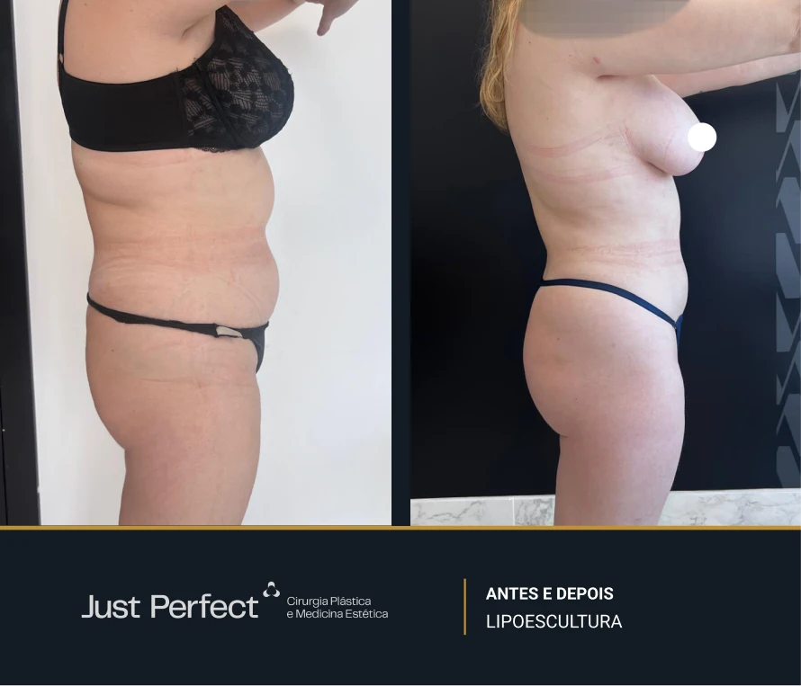 JP_-_antes_e_depois_-_Lipo_5