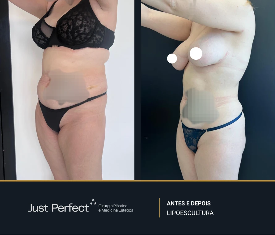 JP_-_antes_e_depois_-_Lipo_9