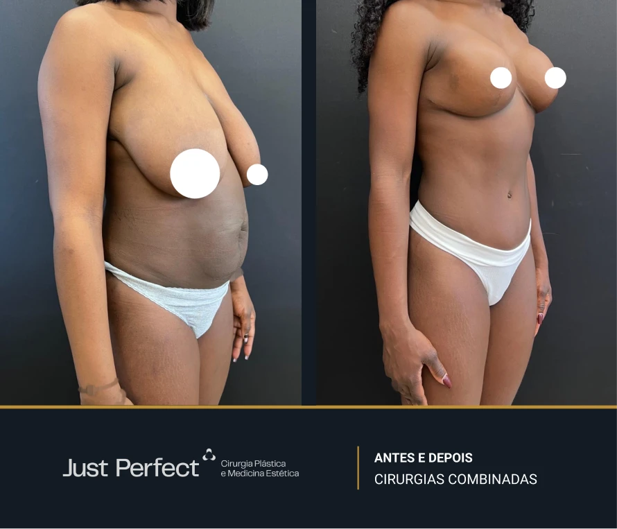 JP_-_antes_e_depois_-_combinadas_2