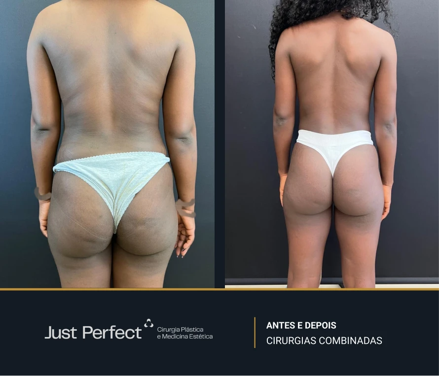 JP_-_antes_e_depois_-_combinadas_4