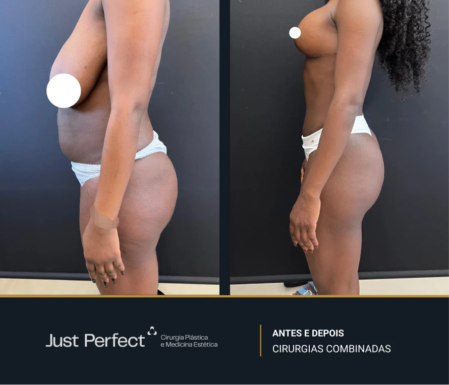 JP_-_antes_e_depois_-_combinadas_5