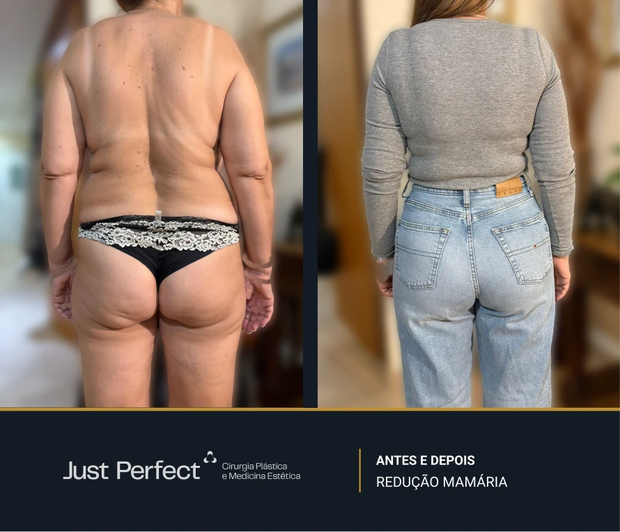 JP_-_antes_e_depois_-_reduo_mamria_4