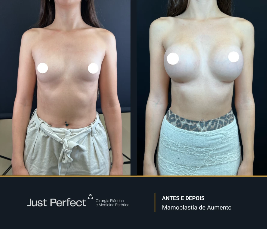 JP_-_antes_e_depois_-_Mamoplastia_de_Aumento_01