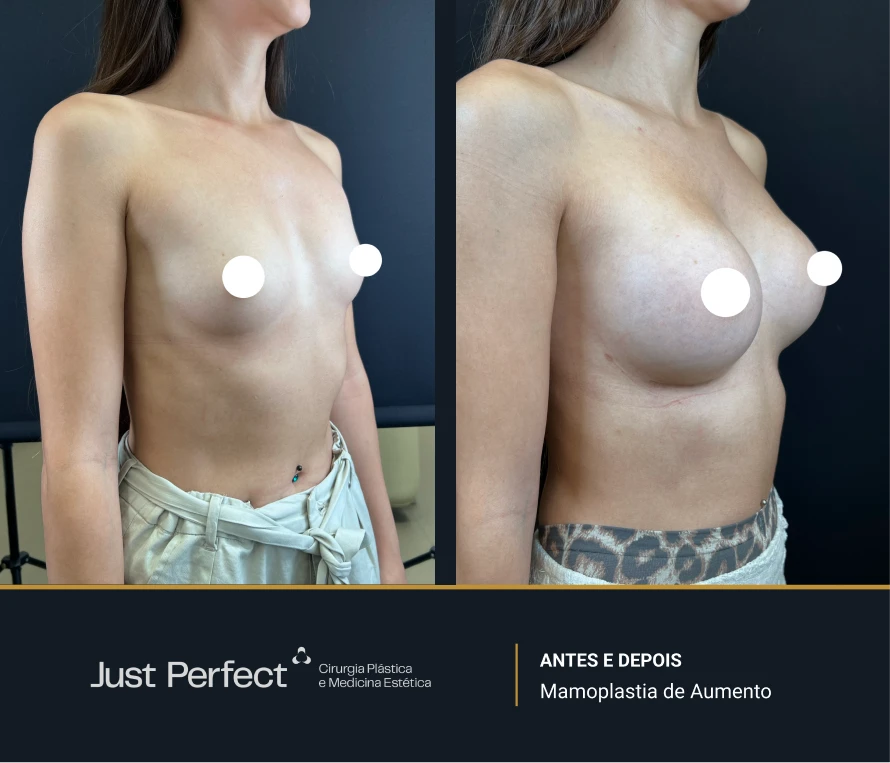 JP_-_antes_e_depois_-_Mamoplastia_de_Aumento_2