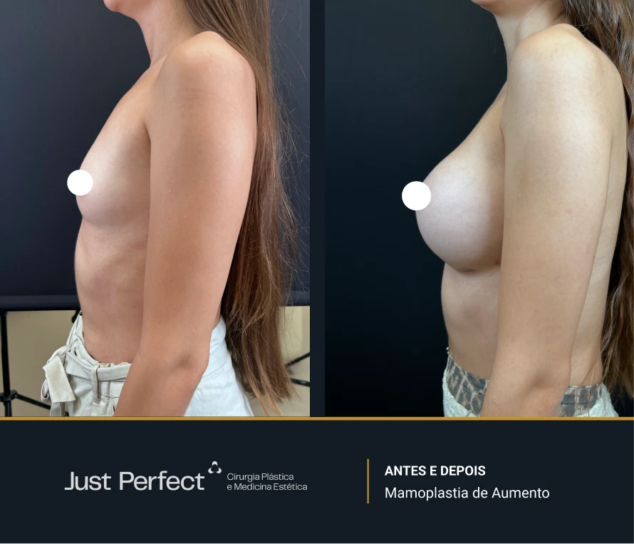 JP_-_antes_e_depois_-_Mamoplastia_de_Aumento_3