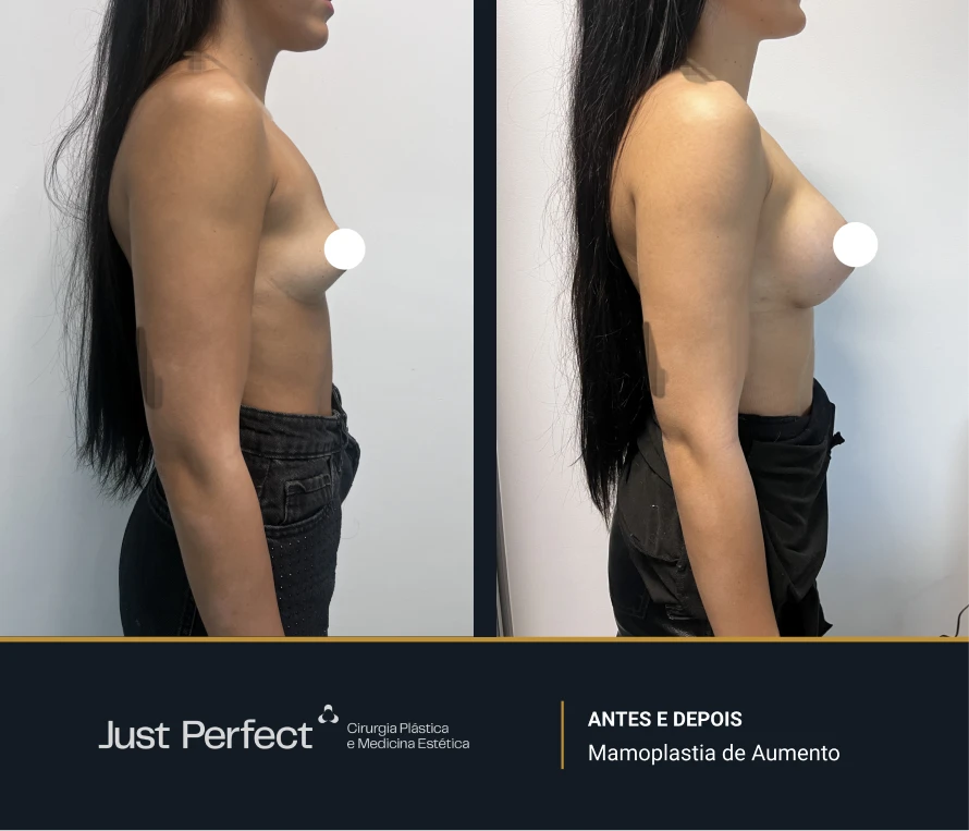 JP_-_antes_e_depois_-_Mamoplastia_de_Aumento_4