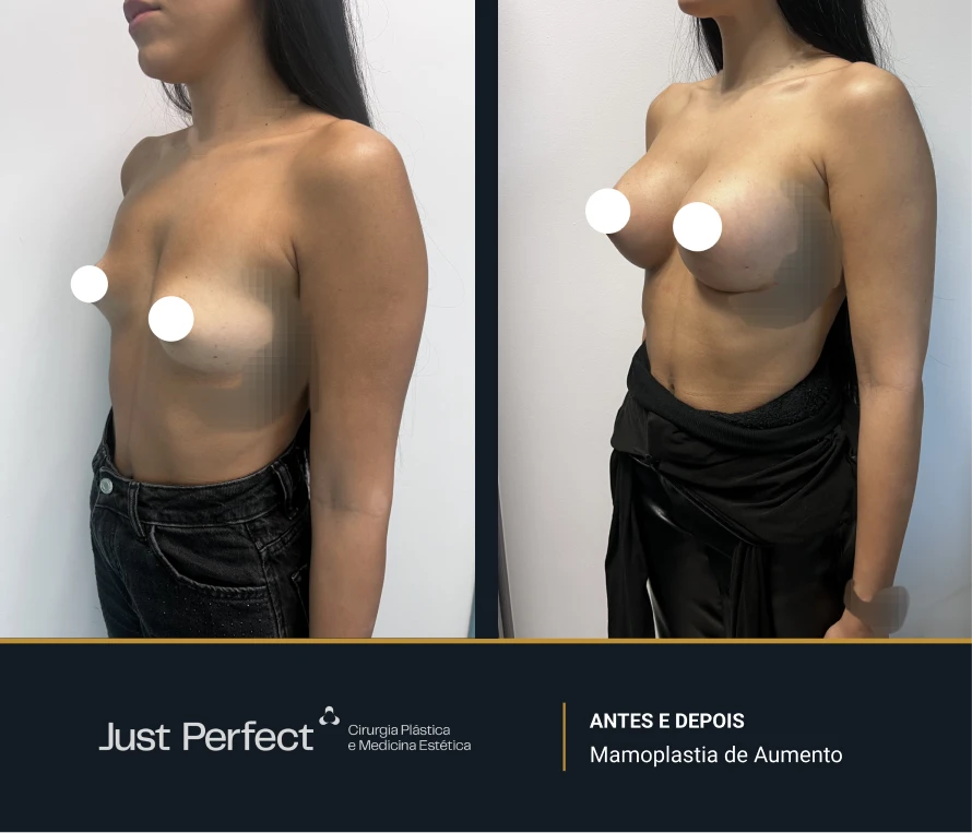 JP_-_antes_e_depois_-_Mamoplastia_de_Aumento_5