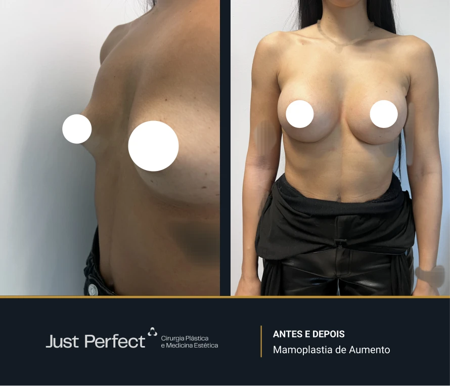 JP_-_antes_e_depois_-_Mamoplastia_de_Aumento_6