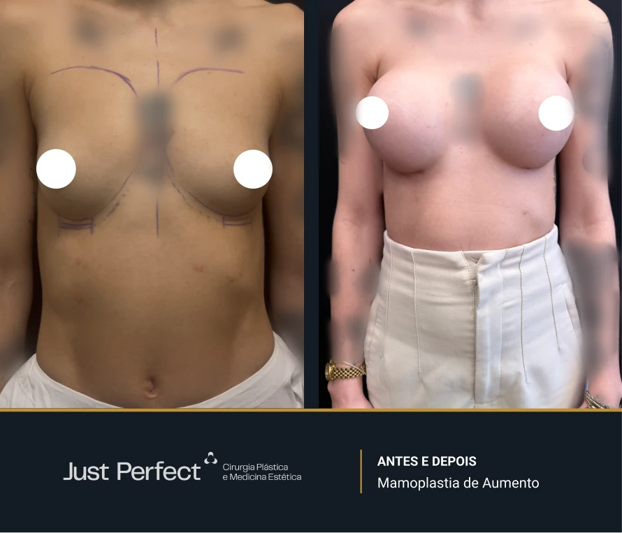 JP_-_antes_e_depois_-_Mamoplastia_de_Aumento_7