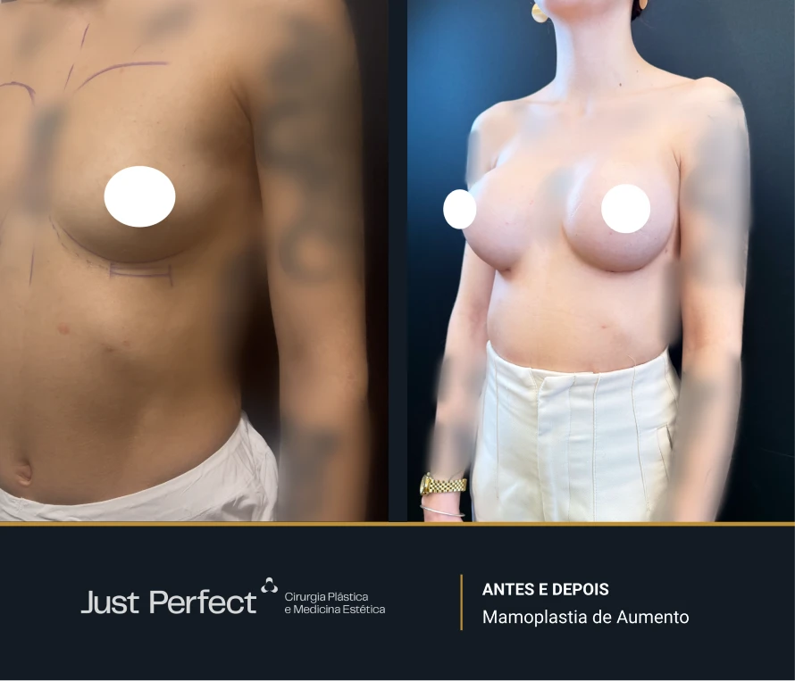 JP_-_antes_e_depois_-_Mamoplastia_de_Aumento_8