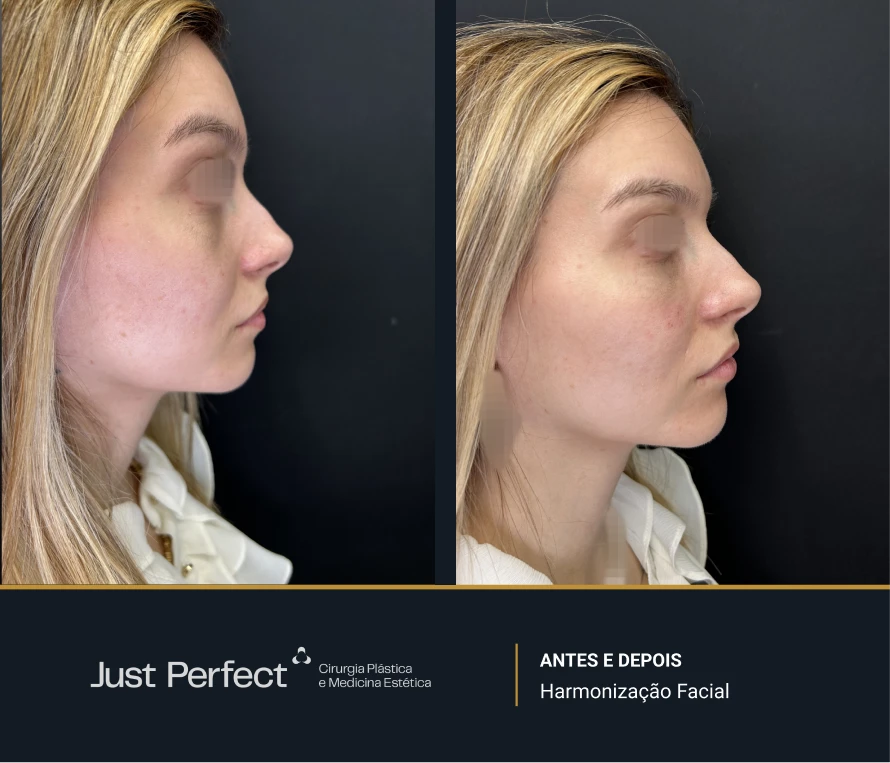 JP_-_antes_e_depois_-_Harmonizao_facial_01