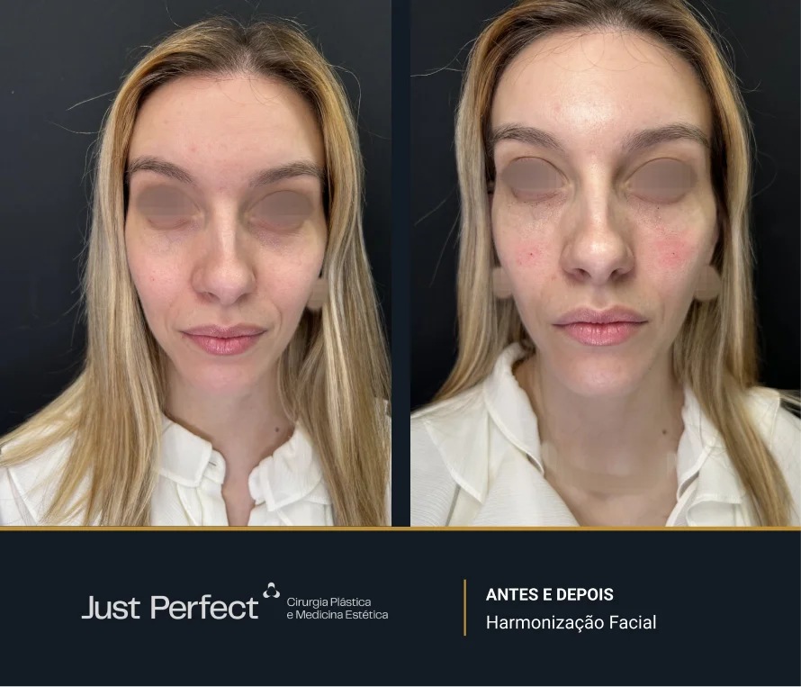 JP_-_antes_e_depois_-_Harmonizao_facial_3