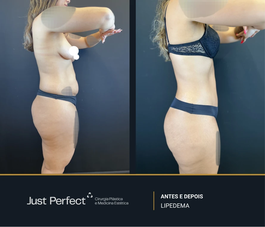 JP_-_antes_e_depois_-_LIPEDEMA_1