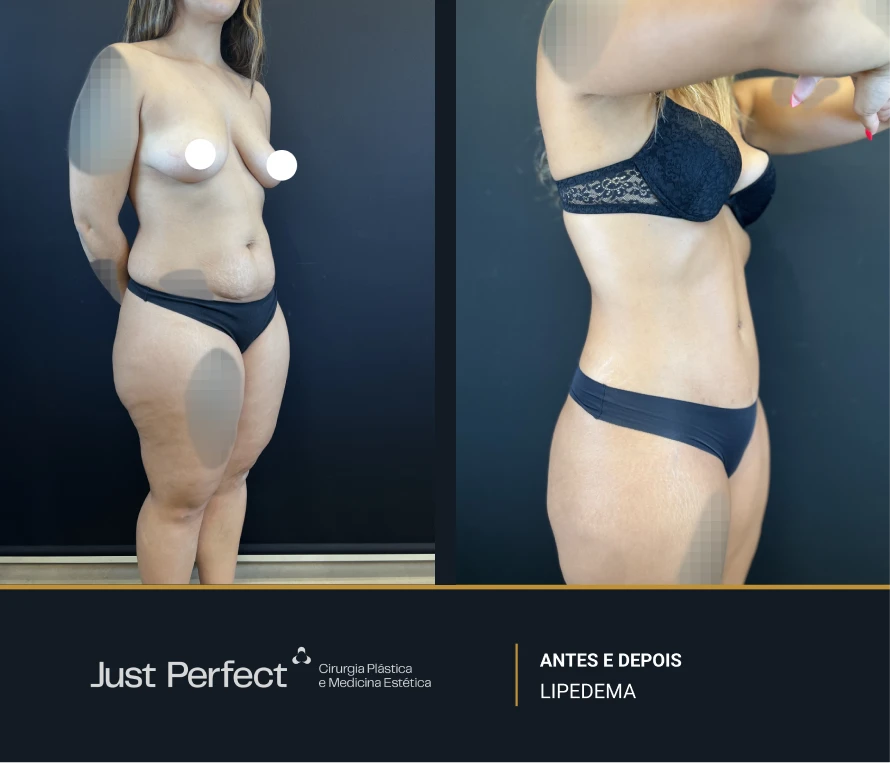 JP_-_antes_e_depois_-_LIPEDEMA_2