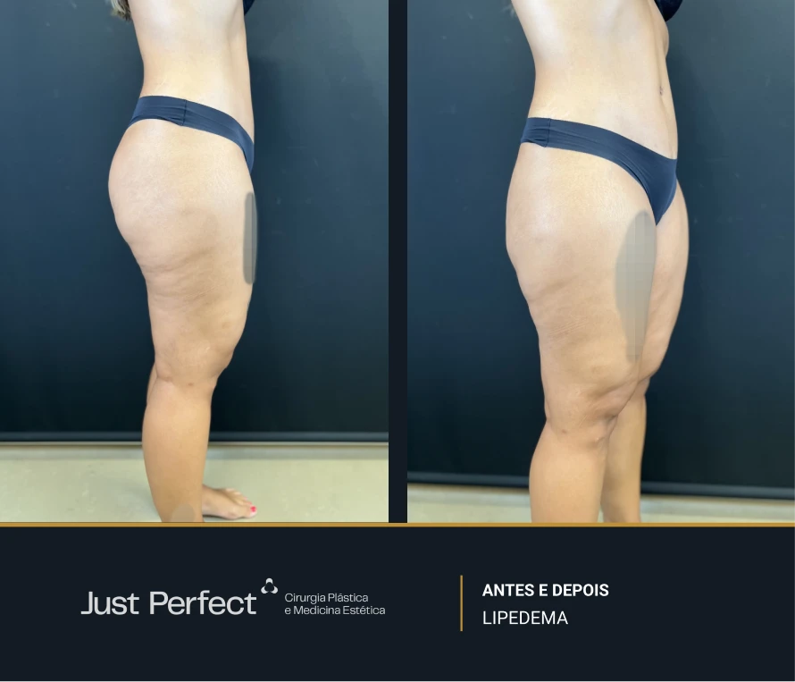 JP_-_antes_e_depois_-_LIPEDEMA_4