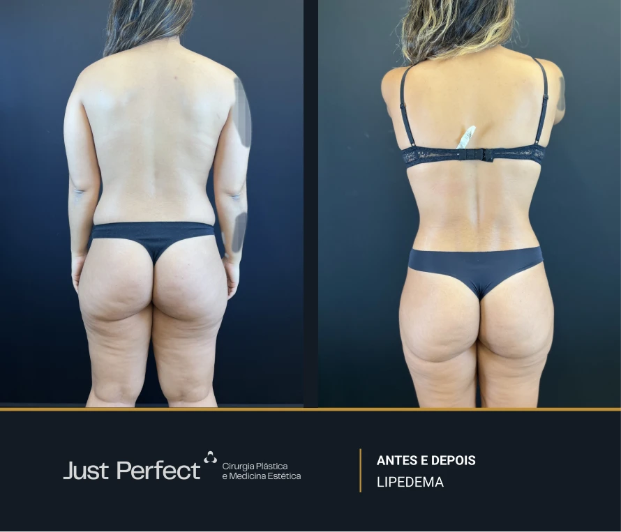 JP_-_antes_e_depois_-_LIPEDEMA_5