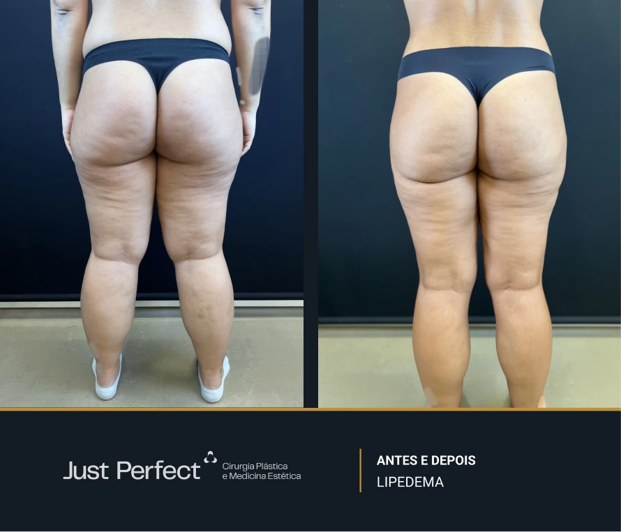 JP_-_antes_e_depois_-_LIPEDEMA_6