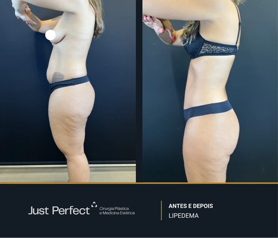 JP_-_antes_e_depois_-_LIPEDEMA_8