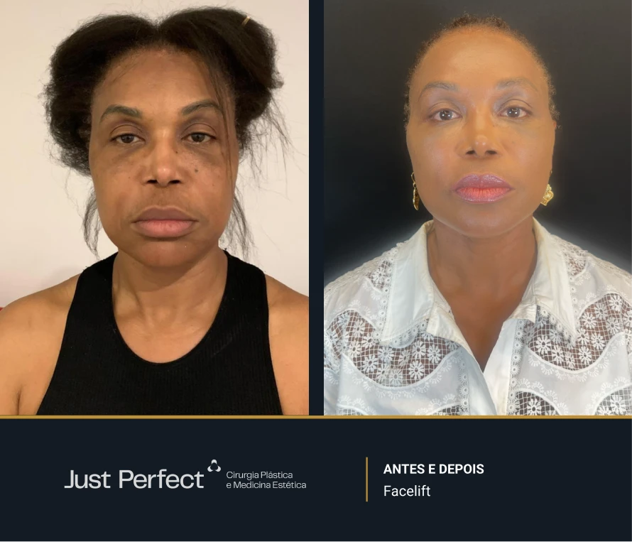 JP_-_antes_e_depois_-_facelift_2