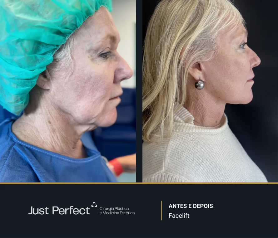 JP_-_antes_e_depois_-_facelift_6