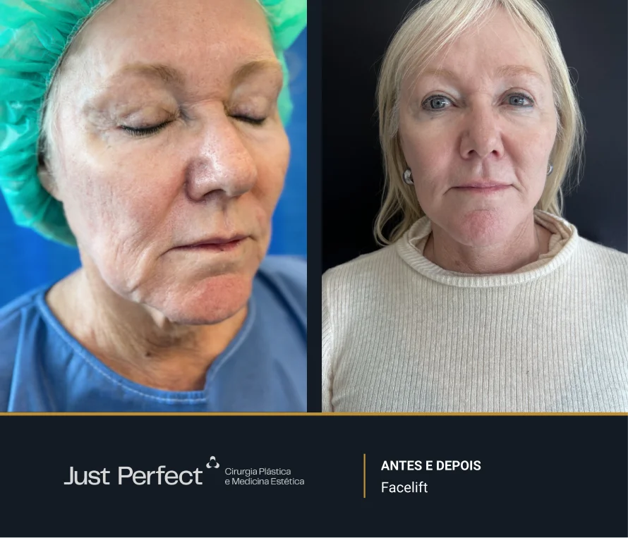 JP_-_antes_e_depois_-_facelift_8
