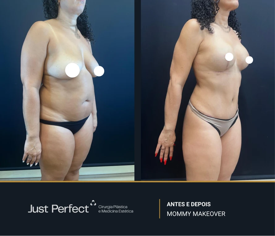 JP_-_antes_e_depois_-_Mommy_11