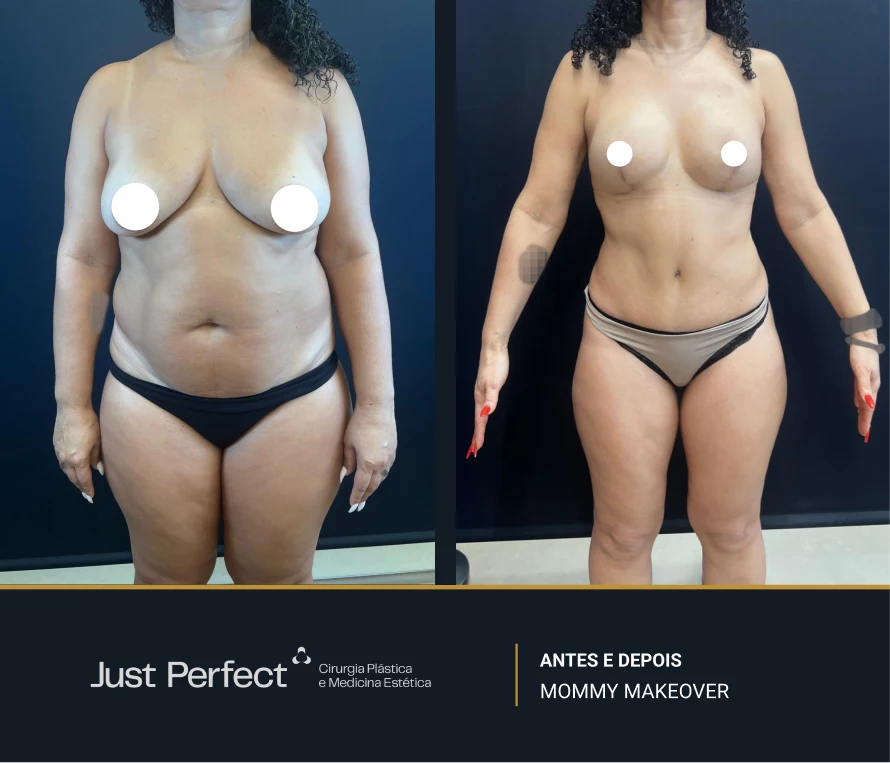 JP_-_antes_e_depois_-_Mommy_12