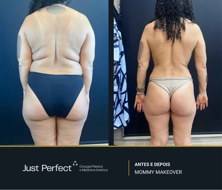 JP_-_antes_e_depois_-_Mommy_13
