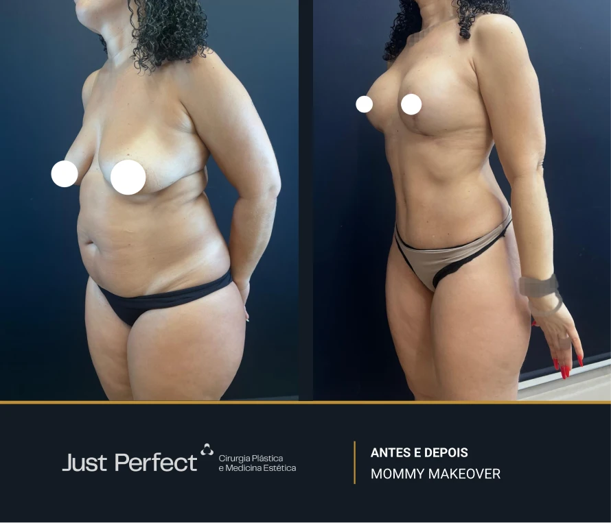 JP_-_antes_e_depois_-_Mommy_14