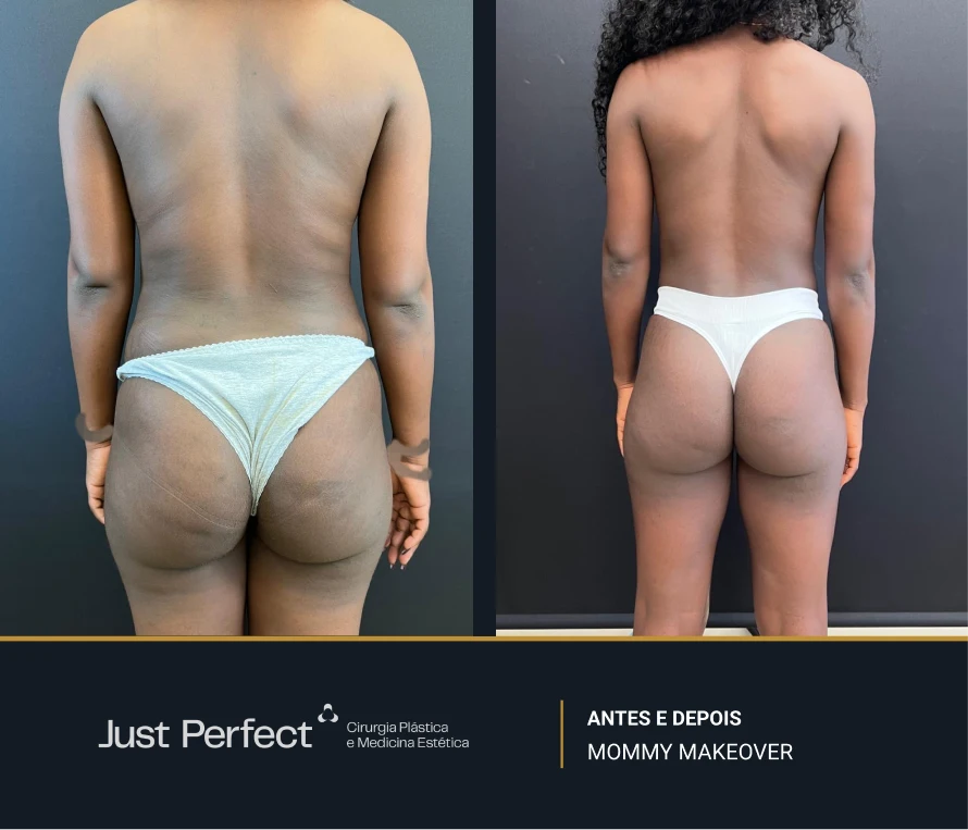 JP_-_antes_e_depois_-_Mommy_7