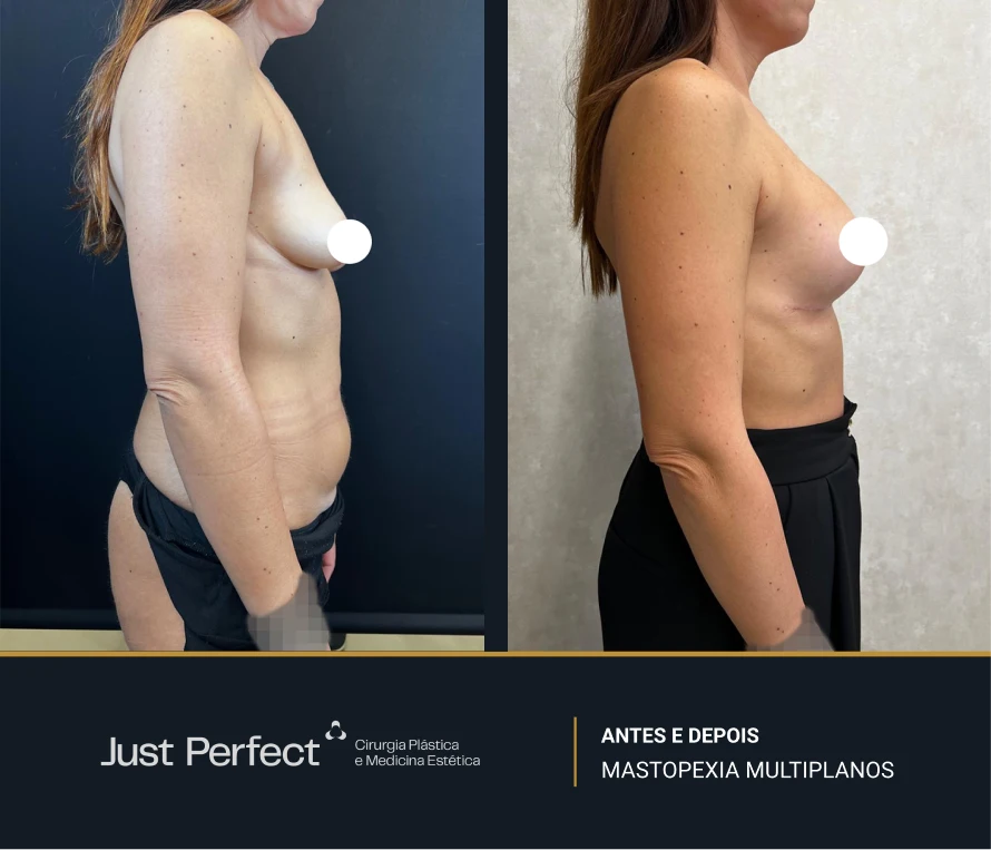 JP_-_antes_e_depois_-_masto_1