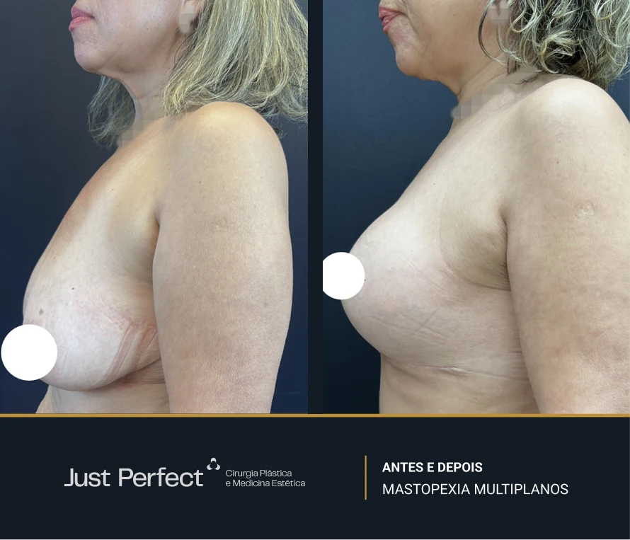 JP_-_antes_e_depois_-_masto_10