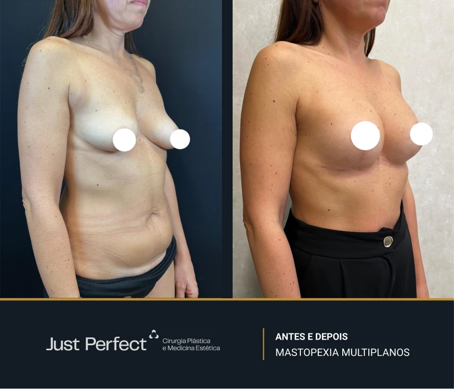 JP_-_antes_e_depois_-_masto_2