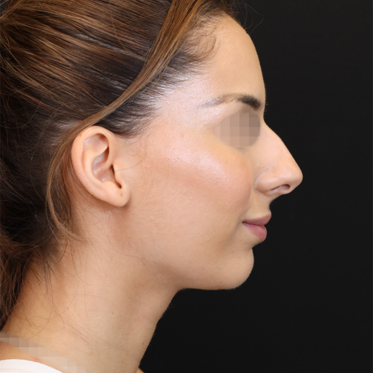 #029_rinoplastia_antes_01