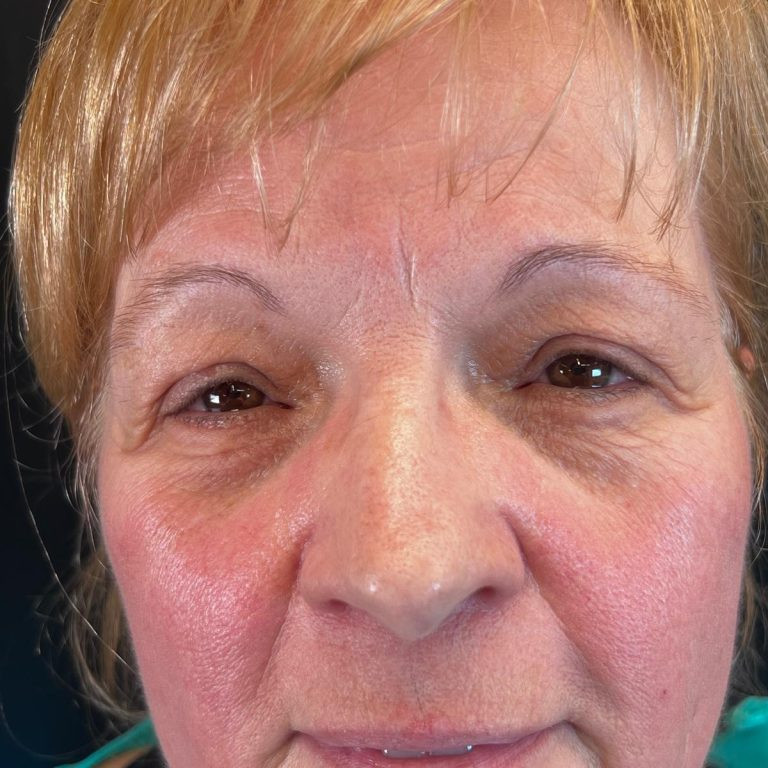 Capa_Blefaroplastia