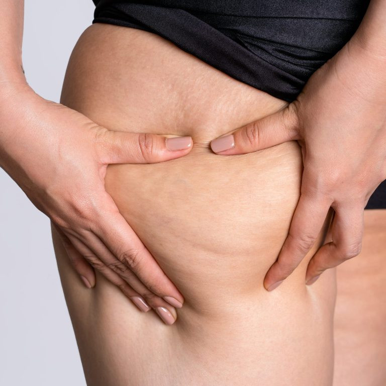 Woman showing cellulite on legs like orange peel skin The concept of treatment and elimination of excess weight.