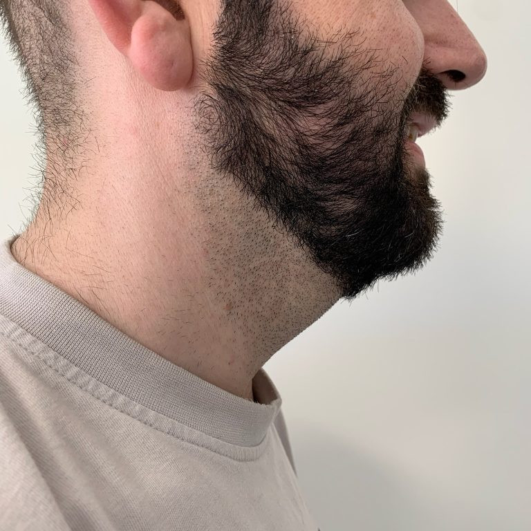 Capa_Necklift