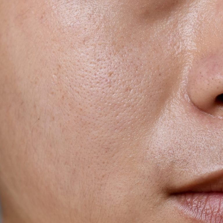 Fair skin with wide pores in face of Southeast Asian, Myanmar or Korean adult young man. Closeup view.